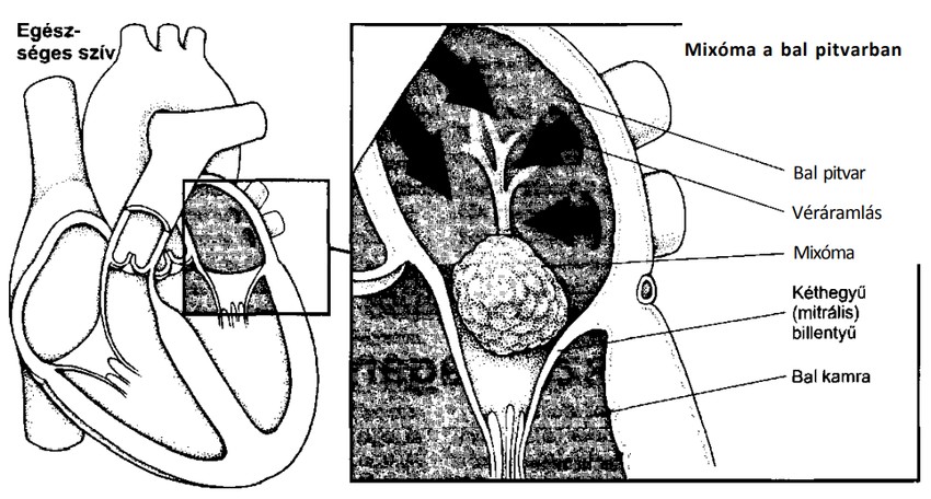 Egészséges szív, illetve mixióma a bal pitvarban