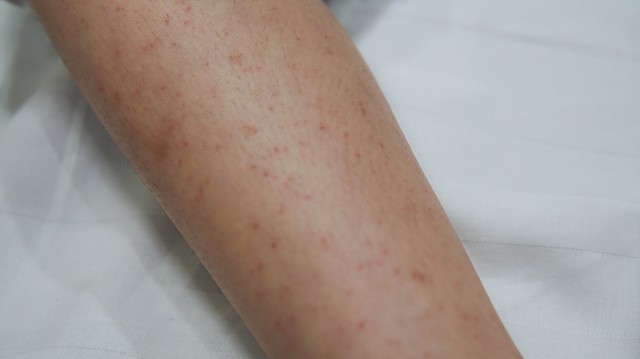 Autoimmun gluténérzékenység: ezek a bőrtünetek jelzik, ha baj van