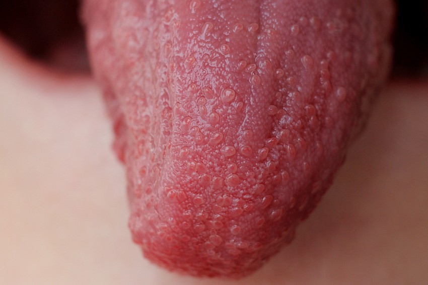 A Kawasaki betegség tünetei: kétoldali, nem váladékozó kötőhártyagyulladás, szájnyálkahártya eltérések: vörös, duzzadt mandulák, málnanyelv, repedezett ajak; nyaki nyirokcsomó megnagyobbodás, tenyéri és talpi duzzanat, pír, mely a második héten a körmök körüli hámlással kezd gyógyulni, gáttájékról induló, majd törzsre és végtagokra terjedő kiütés.