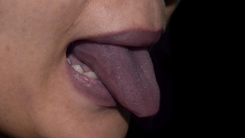 szederjesség cyanosis, kékes bőrszín tünet