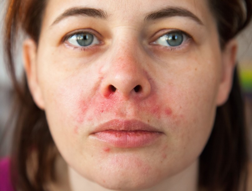 Apró hólyagok arc száj körül oka perioralis dermatitisz