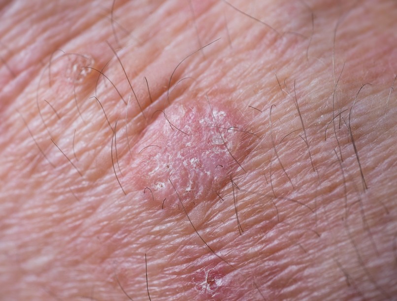 bőrrák jelei rákmegelőző állapot melanóma rákszűrés