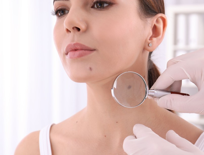 bélbaktériumok meghatározhatják a bőrrák kockázat