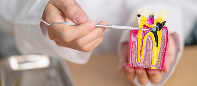 A fogszuvasodás oka, tünetei és kezelési lehetőségei