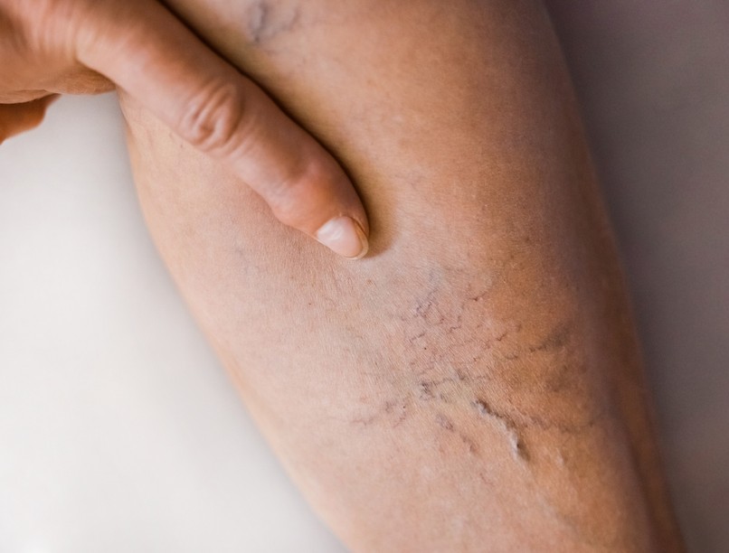 visszér tágulat ellen módszer