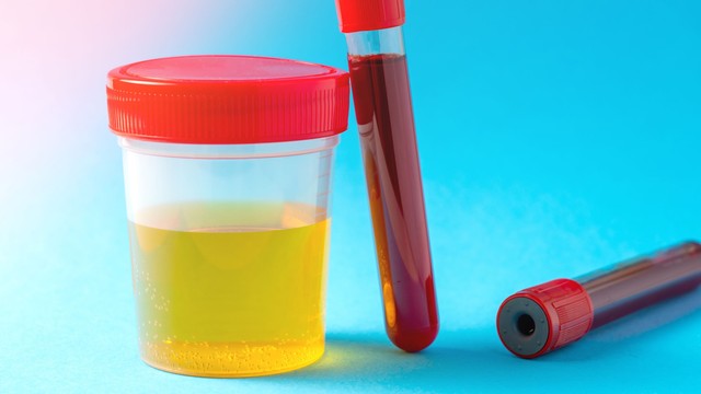 Öt módszer a magas húgysavszint csökkentésére