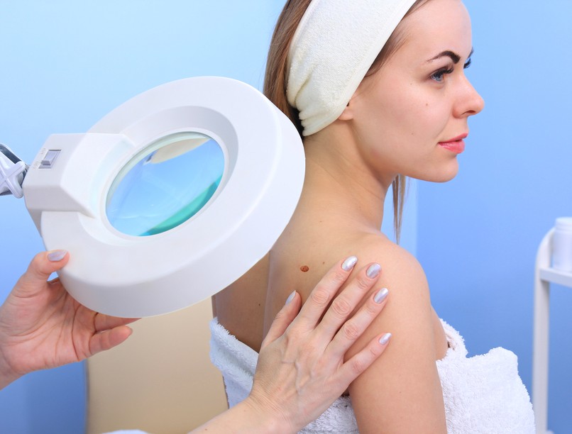 Önvizsgálat, melanóma, bőrrák,  bőrbetegség, bőrelváltozás