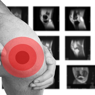 Porcmegújulás: valóban vissza lehet növeszteni a porcokat? című cikk nyitóképe