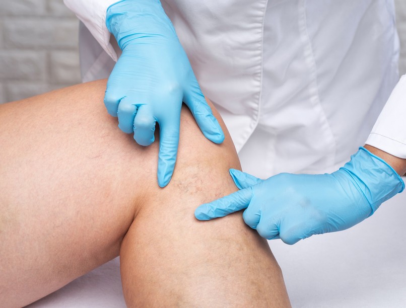 visszérkezelés szkleroterápia kezelés leírás