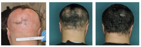 Új gyógyszer a kopaszodás ellen?