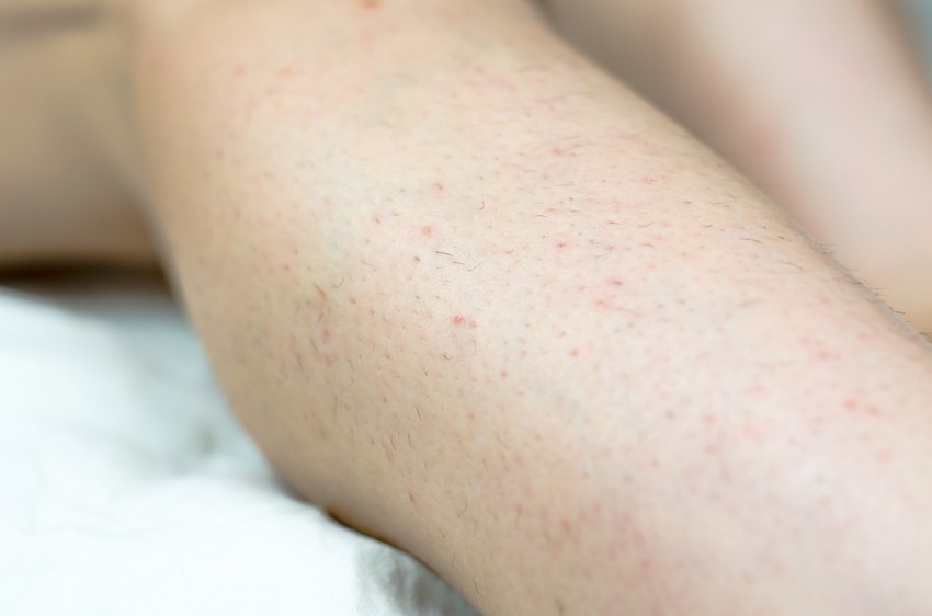 A túlzott szőrösödés általában nem jelenik meg ok nélkül. Ezek okozhatják.