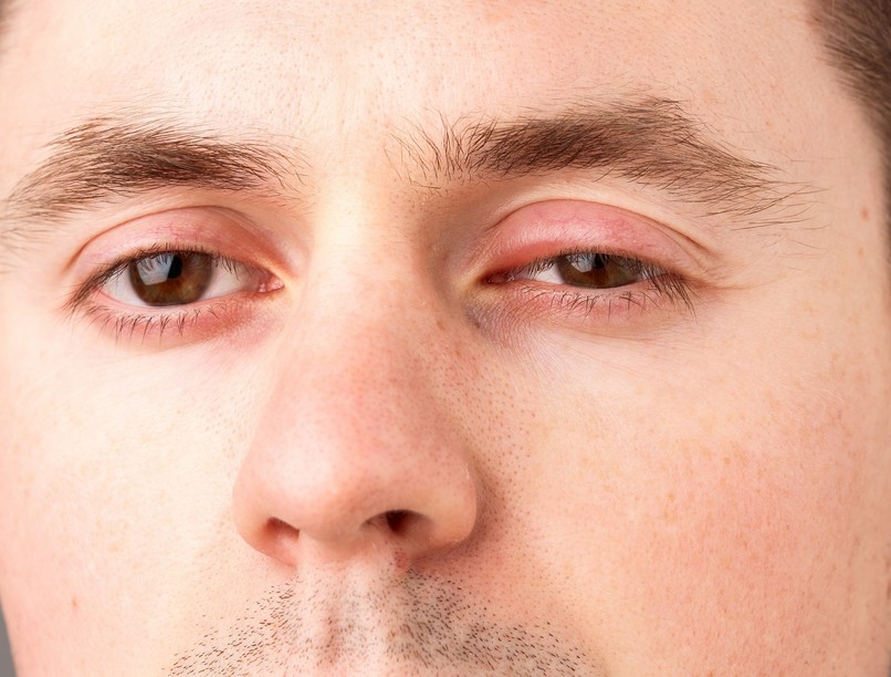 szemhéjduzzanat mire utal