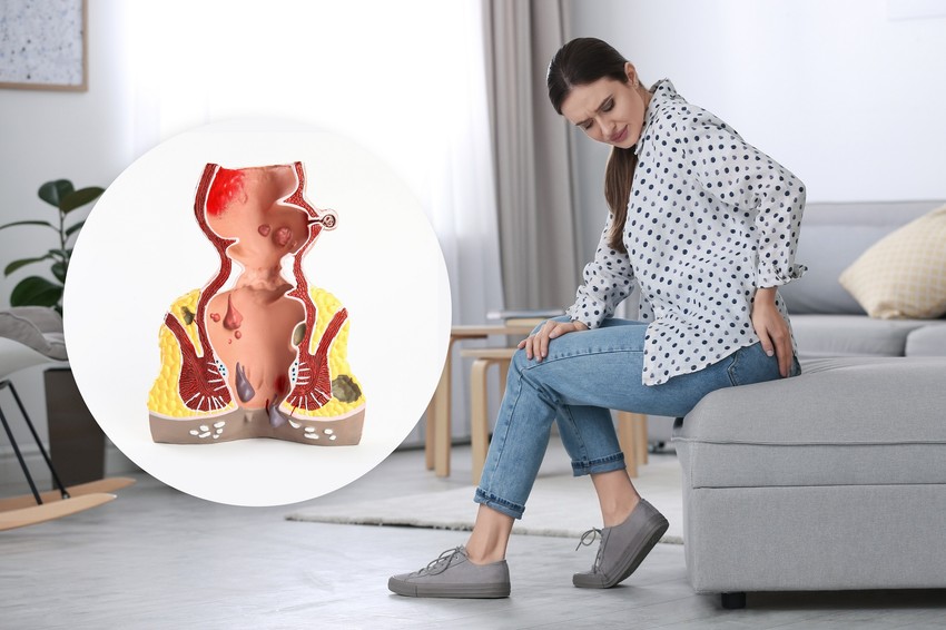 A belső aranyerességnek négy stádiuma van: ha a negyedikben tart, nem halogathatja tovább az orvost!