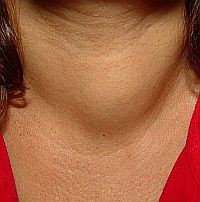 A pajzsmirigy-kezelés évszaktól is függ