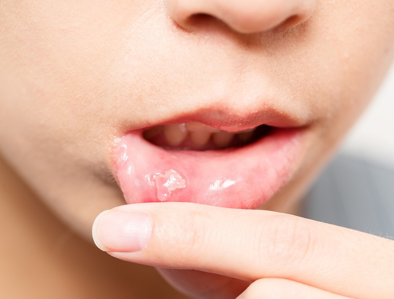 Az afta oka, tünetei és kezelési lehetőségei