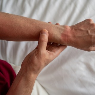 Napallergia: ezt teheti, ha a bőre nem bírja a napfényt! című cikk nyitóképe