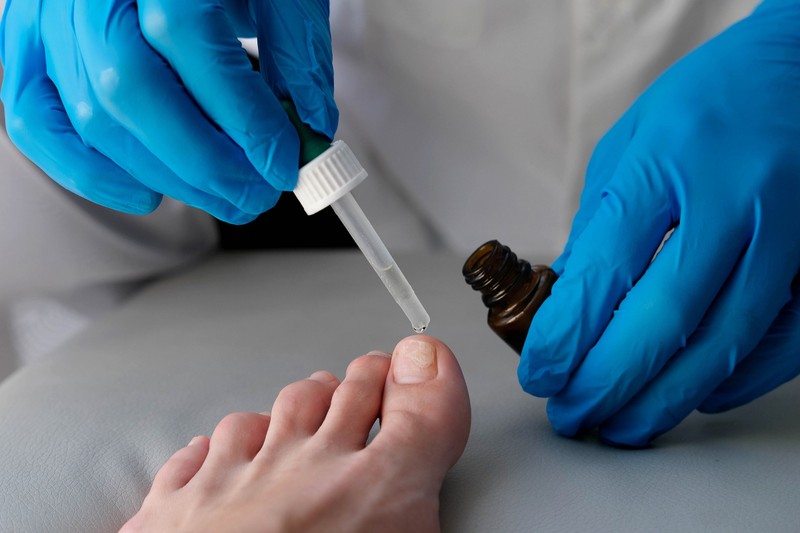 Körömgomba ellen ezt a tanácsot fogadja meg a bőrgyógyásztól!