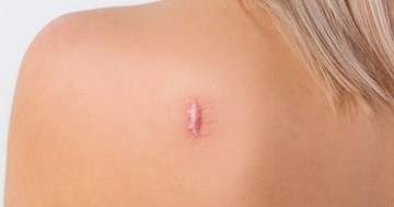  Hegek a bőrön: ezekkel az eljárásokkal lehet eltüntetni, halványítani őket 