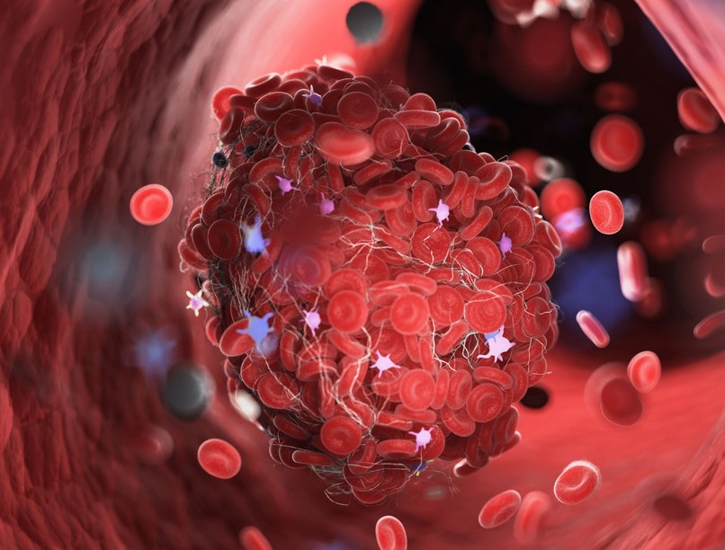 vérzékenység véralvadás DIC véralvadási zavar