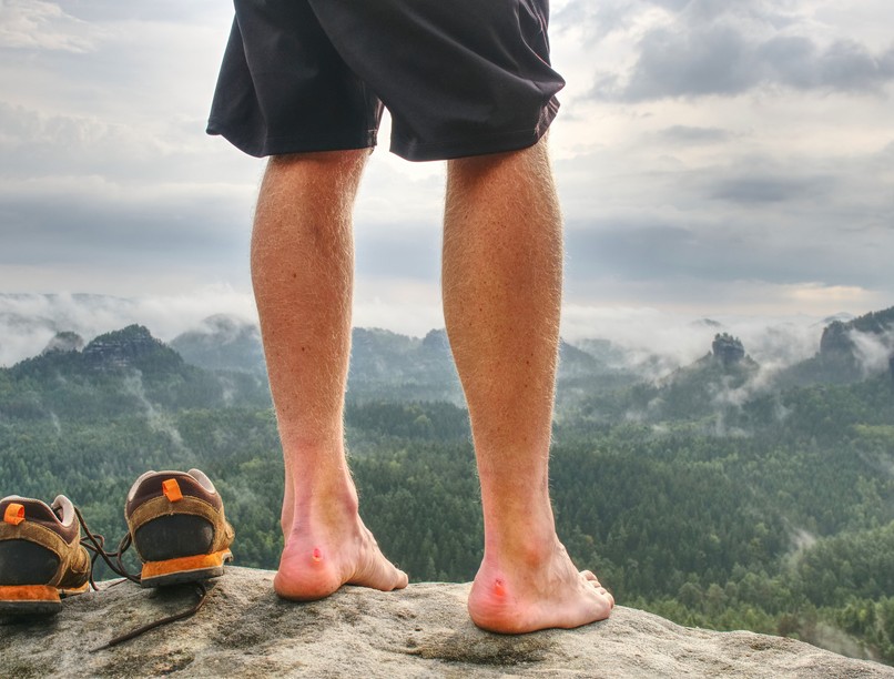 cipő, vízhólyag, fájdalom, kezelés