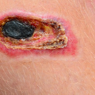 Szöveti nekrózis tünetei, vizsgálata és kezelése című cikk nyitóképe