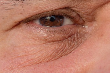 Csüngő szemhéj: ilyen az, amikor belső cisztát jelez