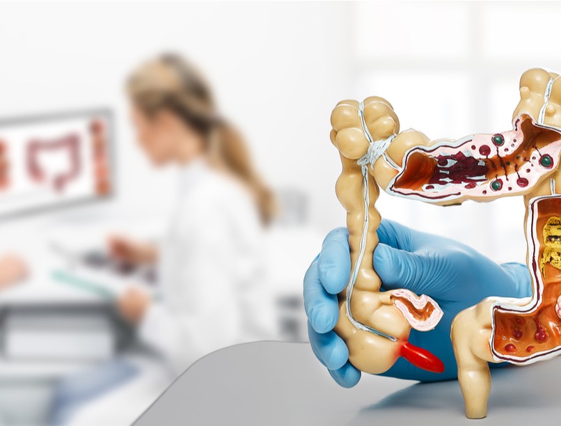 Crohn-betegek, Crohn-betegség, gyulladásos bélbetegség, sipoly, műtét, tünetei