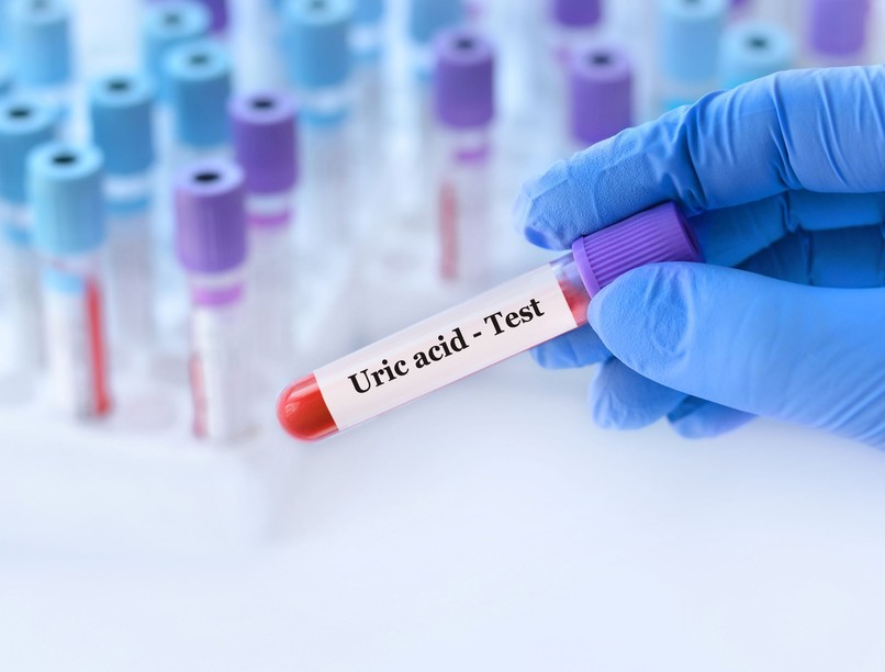 vérvétel magas húgysavszint csökkentése