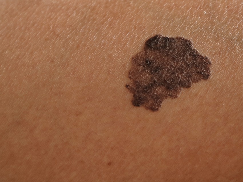 A melanoma a bőrrák leggyakoribb fajtája, és sajnos igen agresszív. Minél előbb fedezik fel, annál kisebb az esély az áttétképződésre.