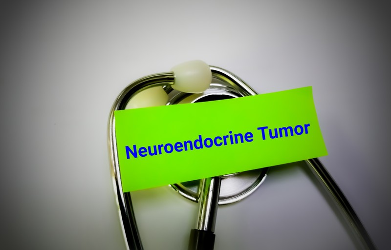 Neuroendokrin daganatok: tünetek, vizsgálatok és kezelési lehetőségek