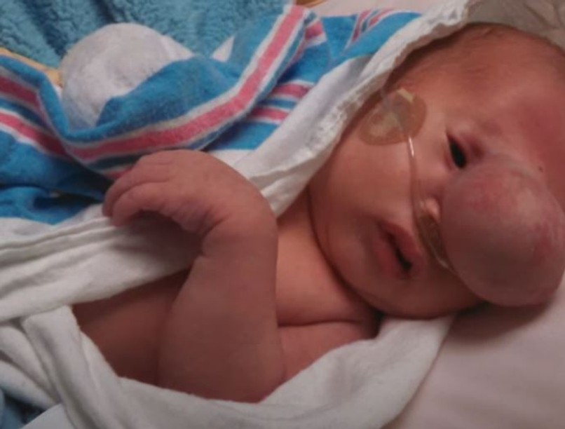 kisbaba, daganat, fejlődési rendellenesség, tumor