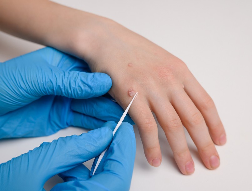 Hogyan szabadulhatunk meg a szemölcsöktől