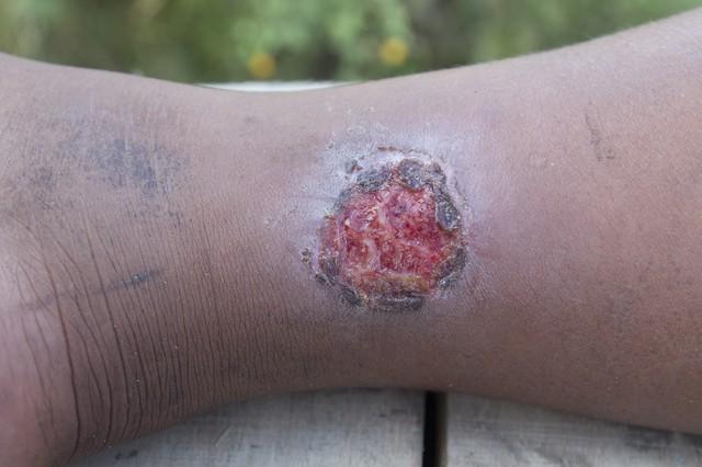 Lökéshullám terápiával kezelhető a fekély