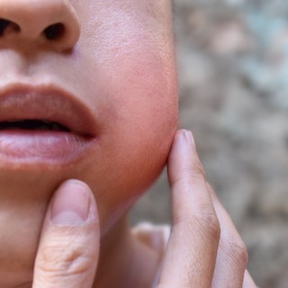 Mumpsz: tünetei, vizsgálata és kezelési lehetőségei című cikk nyitóképe