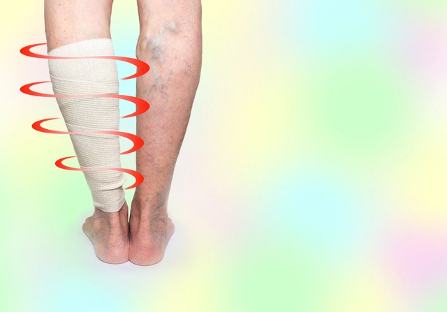 Vénafalgyulladás (tromboflebitisz): okai, tünetei, kezelése és megelőzése