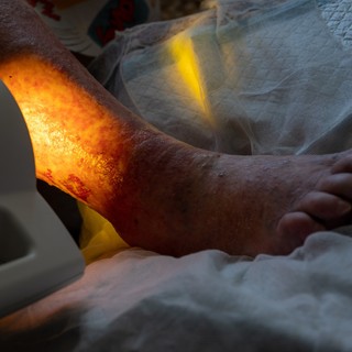 Lábszárfekély oka tünetei kezelése című cikk nyitóképe