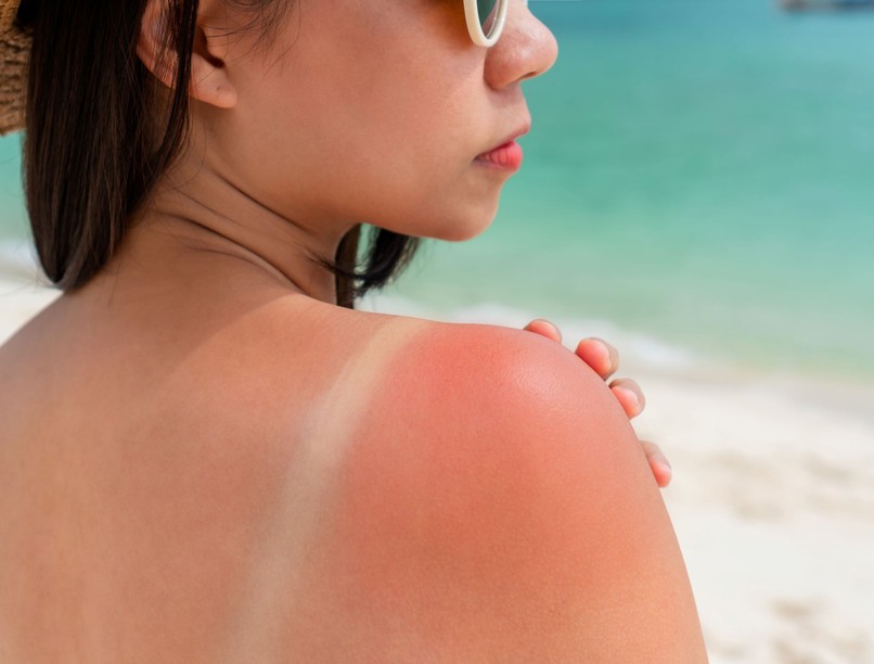 Fitzpatrick-skála, napégés, leégés, napozás, bőrrák, melanin