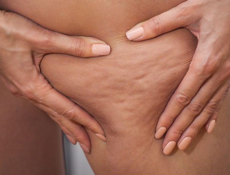 narancsbőr nyiroködéma különbség  nyirokkeringés