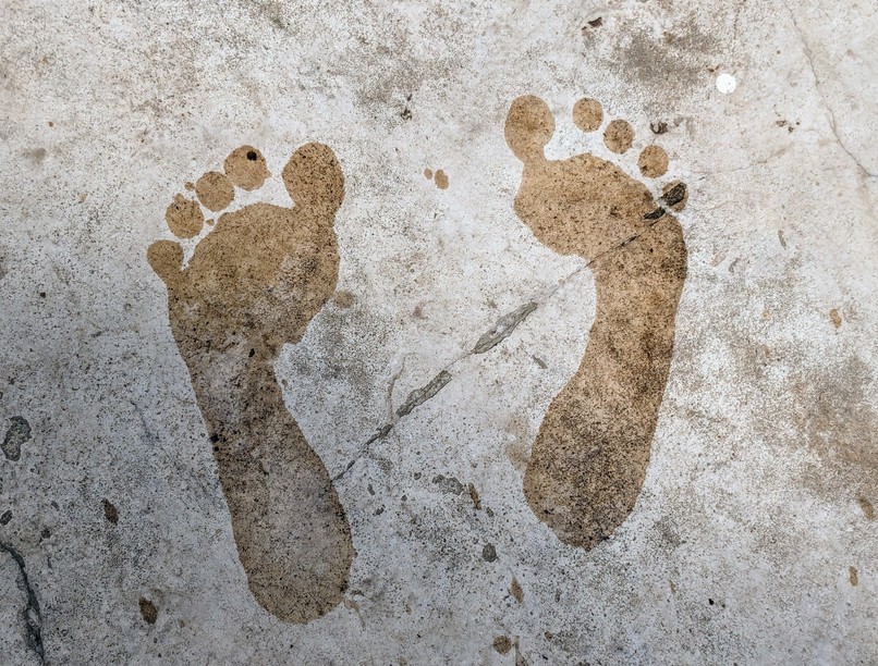 lábnyom mutat lúdtalp Achilles-ín rövidülés bokasüllyedés