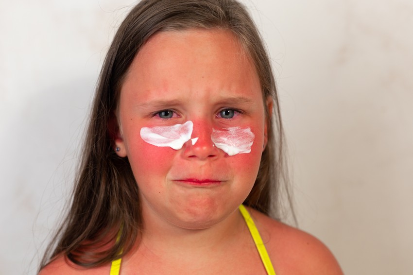 A gyerekek és az 1-es, illetve 2-es bőrtípusú emberek csekély természetes védelemmel rendelkeznek, ezért a napozást és a szoláriumot is kerülniük kell. Egyéves kor alatt a leégés sürgősségi eset, azonnal orvoshoz kell vinni a gyermeket! Az idősebbeknél, ha erős fájdalom, hólyagosodás, letargia vagy 38,3 °C feletti láz jelentkezik, szintén forduljon orvoshoz. Enyhébb esetekben fontos, hogy lehűtse a gyermek bőrét, ezért zuhanyozza le tiszta, langyos (ne hideg!) vízzel.