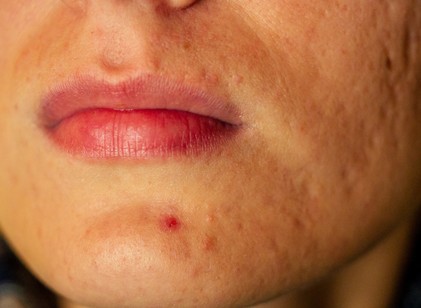 Mit jelez a szervezet az állon megjelenő pattanással? Nem mindig csak bőrprobléma című cikk nyitóképe