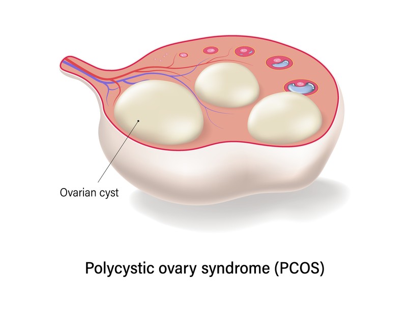 Policisztás ovárium szindróma tünet vizsgálat kezelés