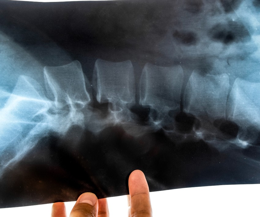 A Bechterew-kór (Spondylitis Ankylopoetica - SpA) egy krónikus, autoimmun gyulladásos betegség, amely elsősorban a gerinc ízületeit, a keresztcsontot, valamint a bordák és a csigolyák közötti ízületeket érinti, az elcsontosodás és a gerinc elmerevedése révén súlyos mozgáskorlátozottságot okozva, gyakran "botmerev gerinc" kialakulásához vezet, férfiaknál gyakoribb, és 20-40 éves kor között kezdődik, de ma már gyógytornával és biológiai terápiákkal jól kezelhető, az életminőség javítható. 