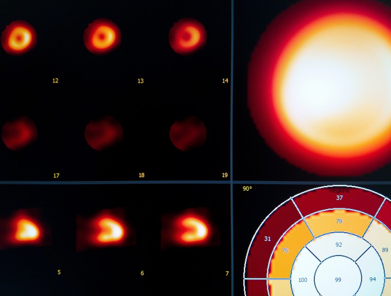 szkintigráfia szcintigráfia izotópos vizsgálat leírás