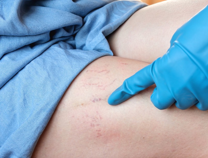 artériás zavarok felismerés vizsgálat