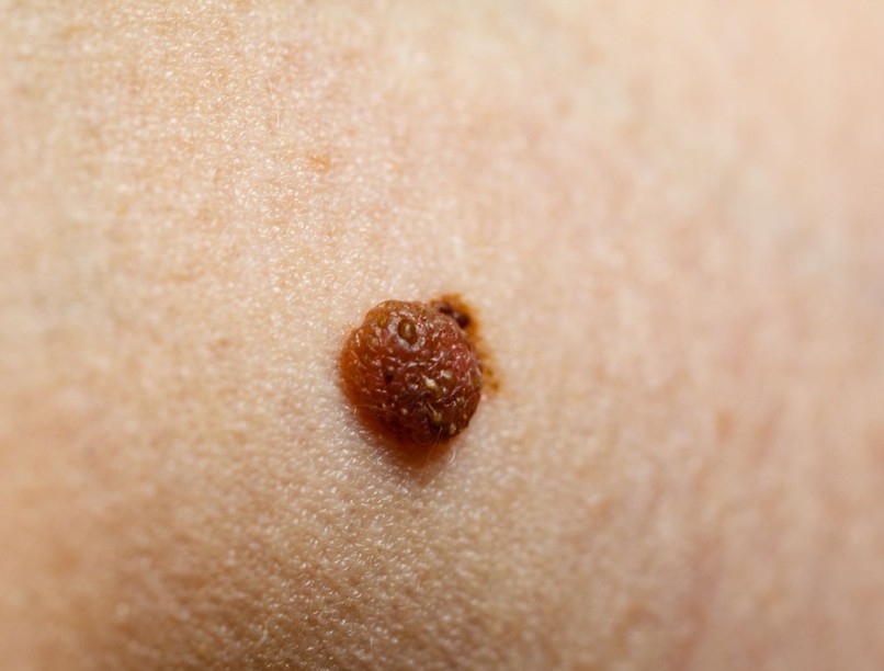 anyajegy, melanoma, bőrrák, tünetei