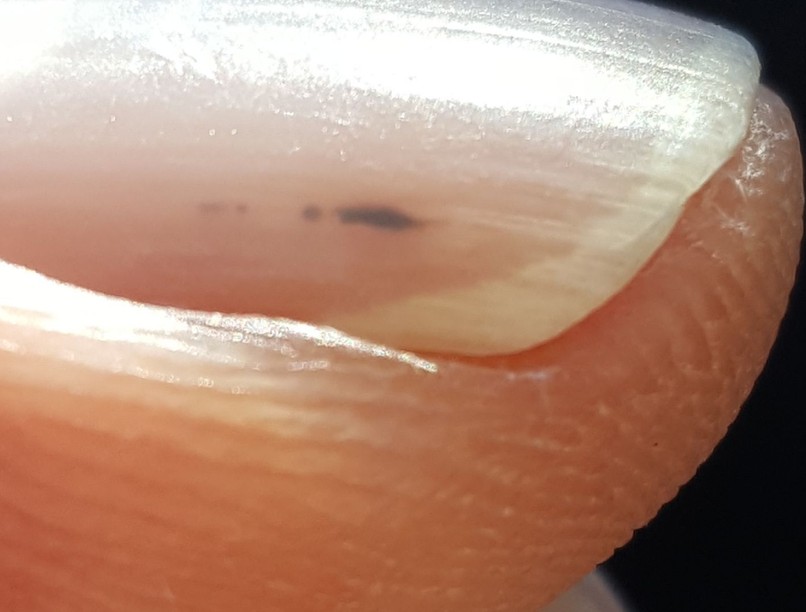 bőrgomba fertőzés mit jelent fekete vonalak köröm