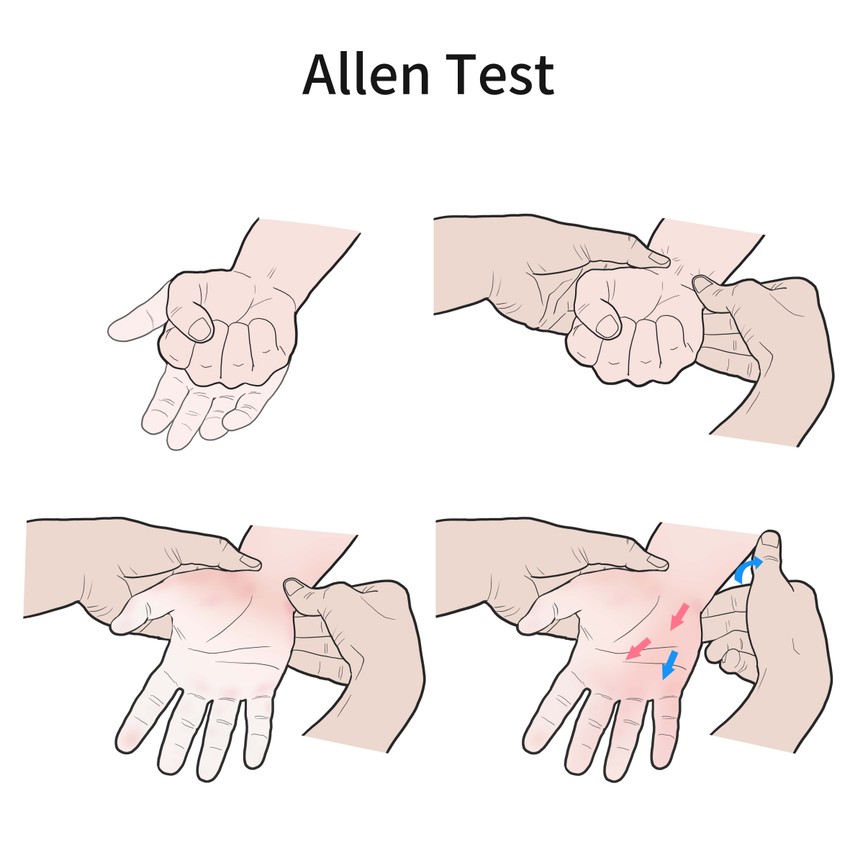 Allen-teszt elvégzése javasolt az ulnaris artéria működésének felméréséhez: a beteg a magasba emeli a karját és ökölbe szorítja a kezét. Az ulnáris és a radiális artériát a vizsgáló személy leszorítja, a vizsgált személy a karját lassan leengedi, a kezét kinyitja. Ezután az ulnáris artéria elszorítását a vizsgáló személy megszünteti. A kéz színének kevesebb, mint 6 másodperc alatt kell visszatérnie.