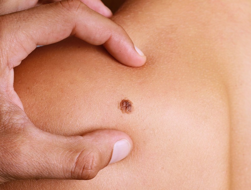 melanóma, bőrrák, daganat, tumor