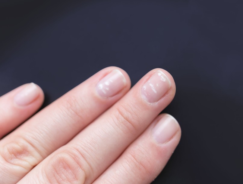 fehér csíkok, pöttyök körmön vitaminhiány pajzsmirigy